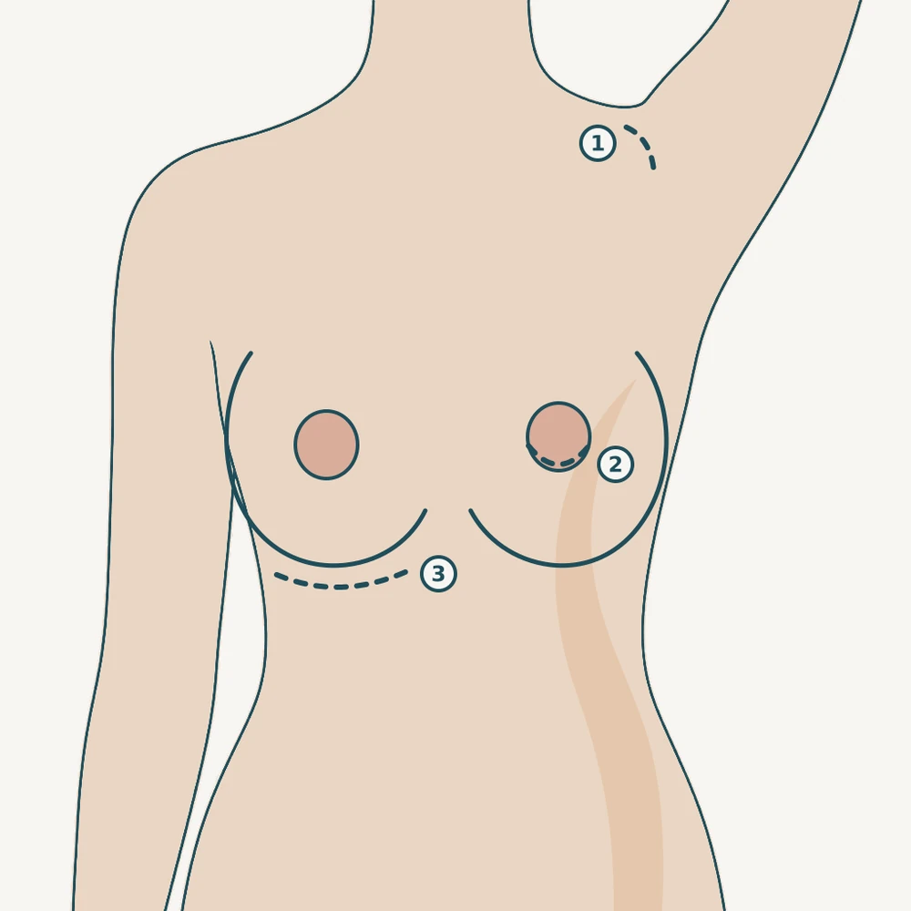 겨드랑이와 유륜, 가슴 아래 주름에 절개 위치를 번호로 표시한 그림