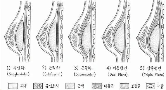 유선하, 근막하, 근육하, 이중평면, 삼중평면 다섯 가지 삽입 층을 나란히 그린 단면도